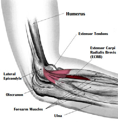 oakville physiotherapy tennis elbow pain