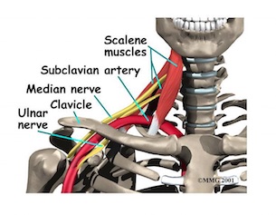 physiotherapy oakville thoracic outlet syndrome