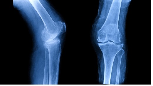 oakville physiotherapist knee replacement rehabilitation